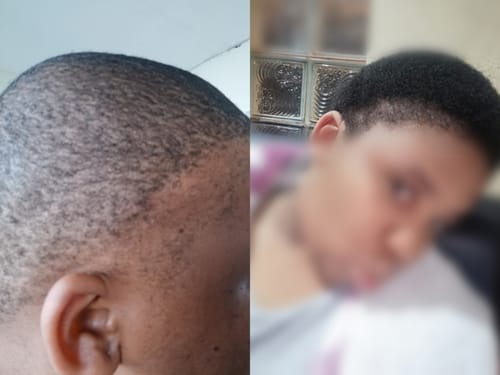 Customer photo review of Minoxidil5% Solution, 1 Pack 60ml