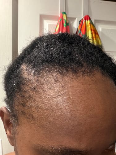 Close-up of a customer's scalp and hairline, showing hair thinning before using Rennora Hair Growth Serum.