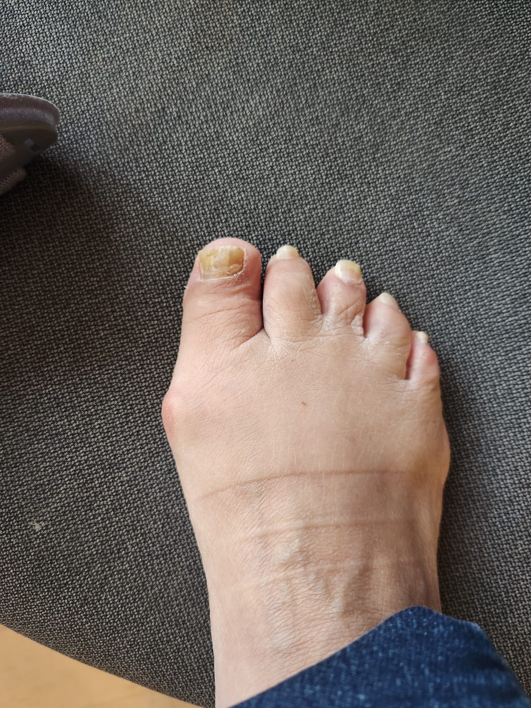 Customer photo review of Treatmedy™ Bunion Fix