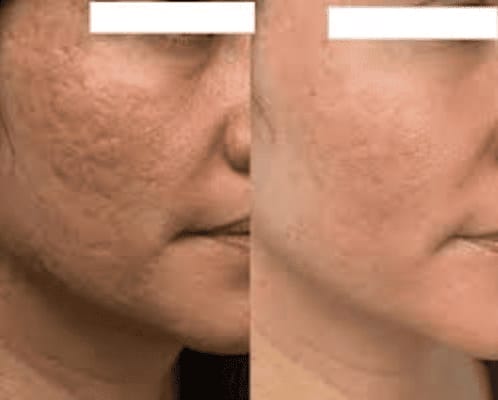 Customer photo review of Serum Reparador Acné Zilen (40ml).