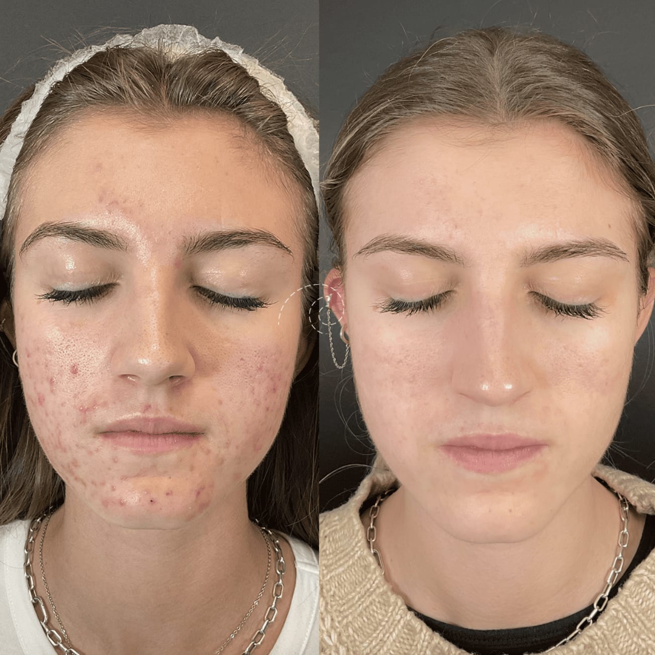 Customer photo review of Serum Reparador Acné Zilen (40ml).