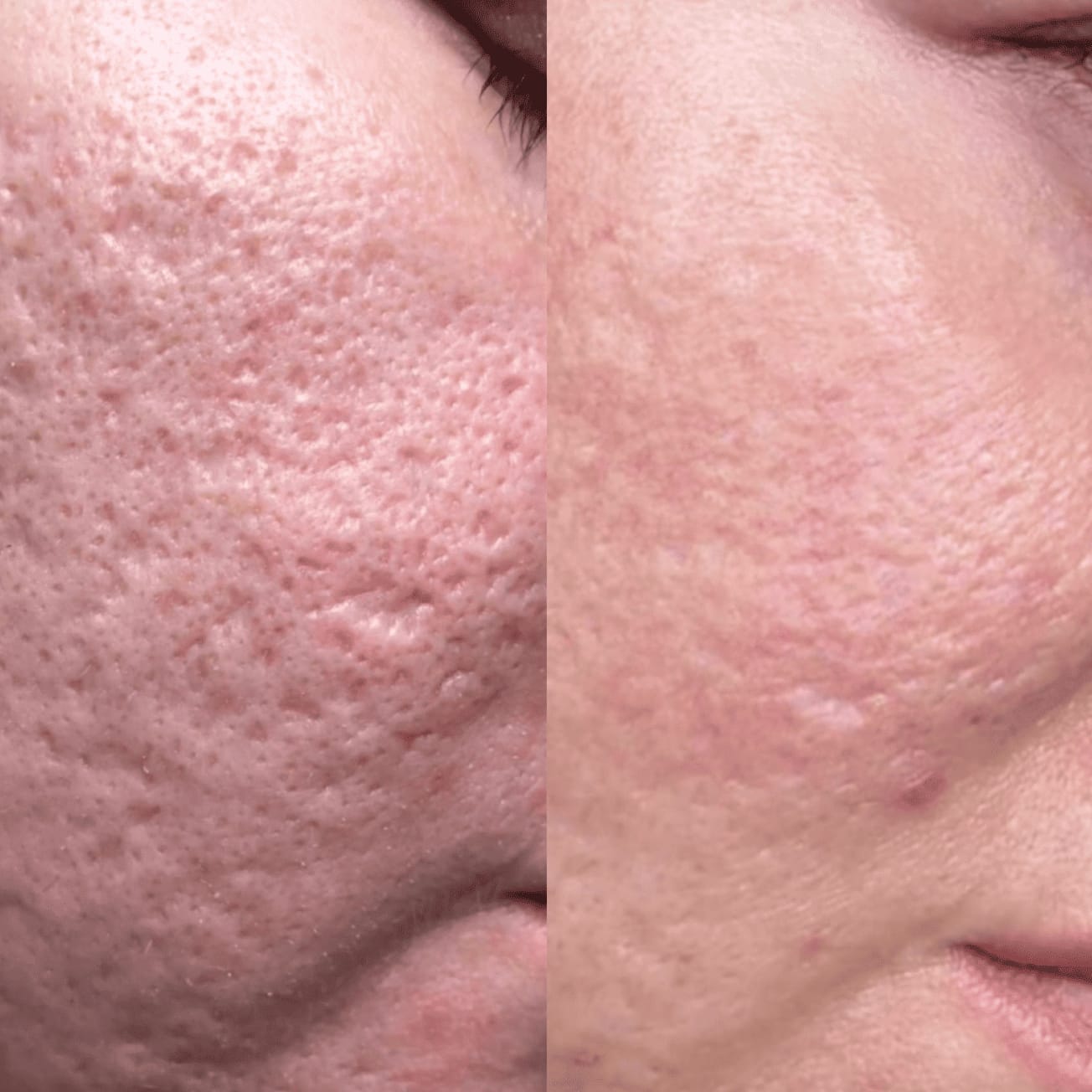 Customer photo review of Serum Reparador Acné Zilen (40ml).