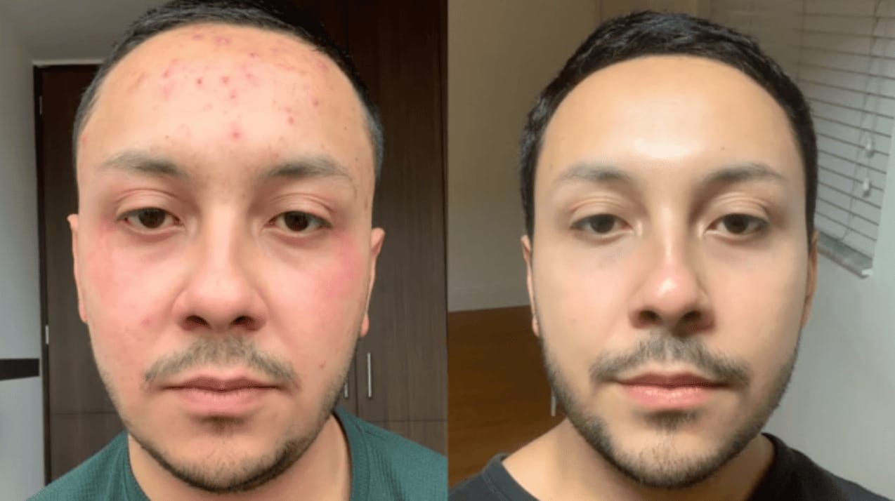 Customer photo review of Serum Reparador Acné Zilen (40ml).