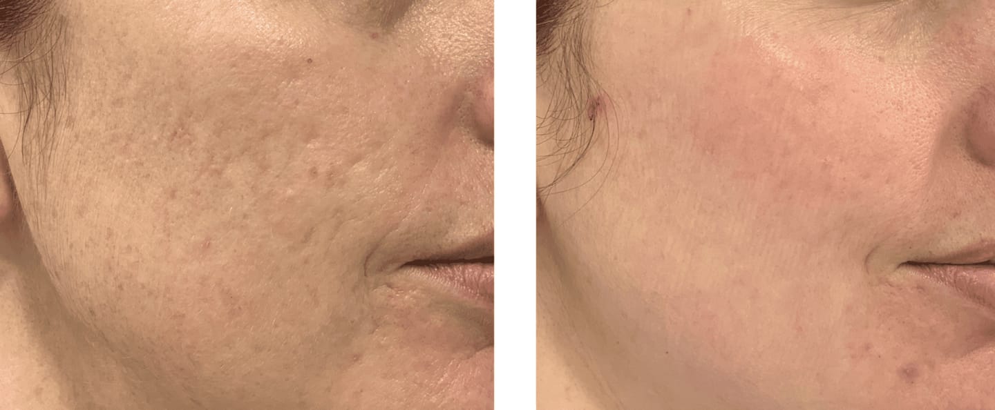 Customer photo review of Serum Reparador Acné Zilen (40ml).