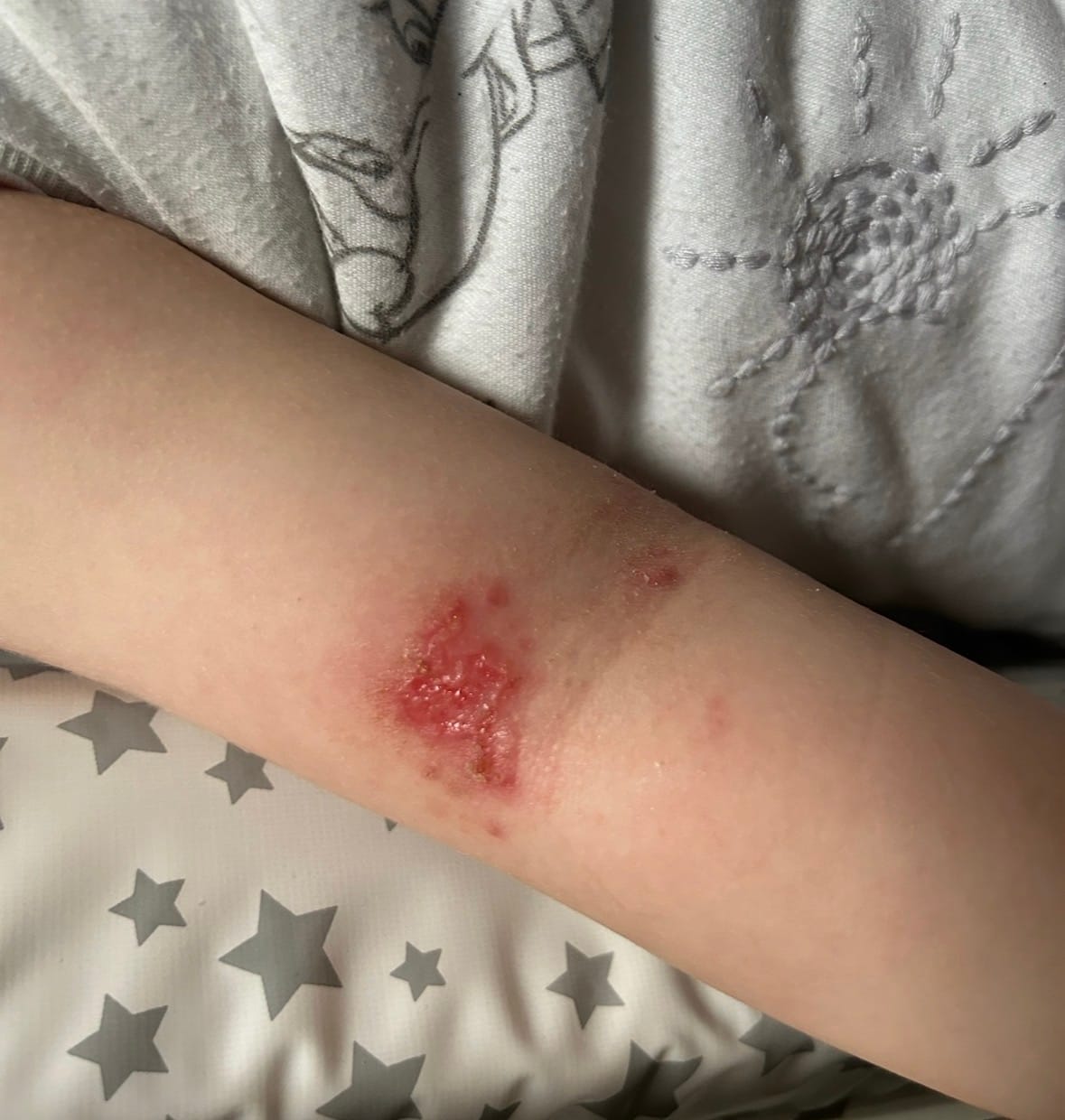 Customer photo review of Bioskin Junior Outbreak Rescue Cream