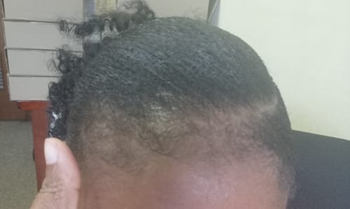 Customer photo review of Minoxidil REGULAR (2%) strength SOLUTION, 3x60ml pack