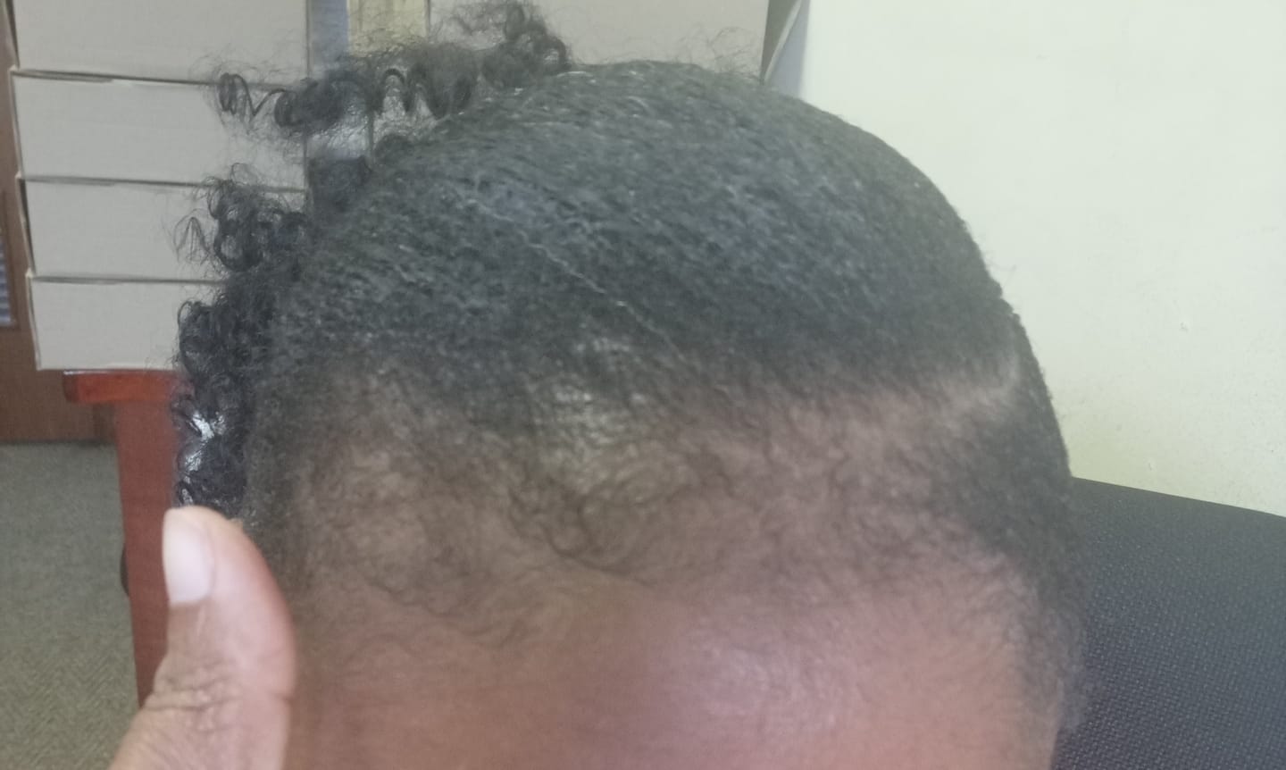 Customer photo review of Minoxidil REGULAR (2%) strength SOLUTION, 3x60ml pack