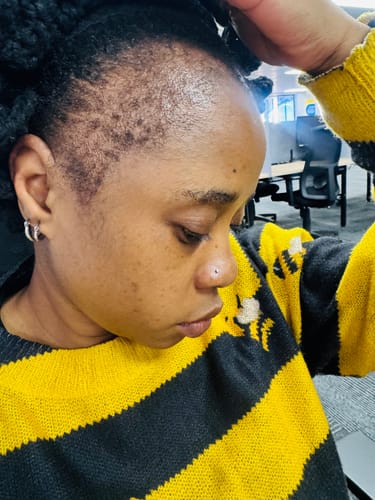 Customer photo review of Minoxidil 5% SOLUTION, 3x60ml pack