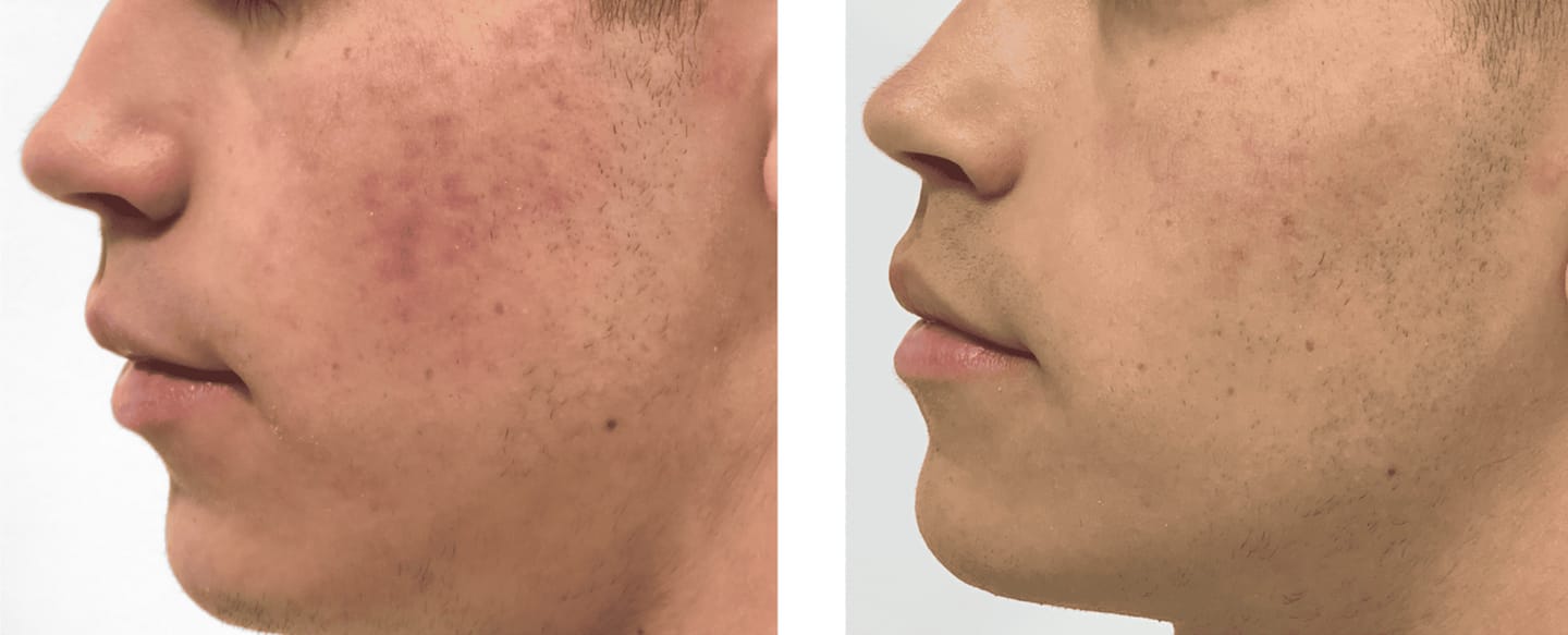 Customer photo review of Serum Reparador Acné Zilen (40ml).