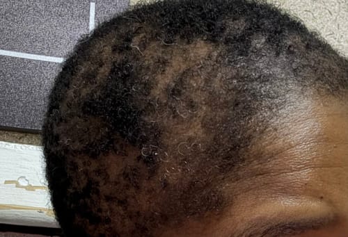 Customer photo review of Minoxidil 5% SOLUTION, 3x60ml pack