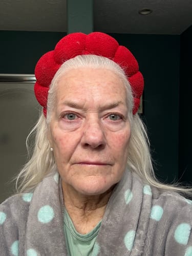 Reviewer's face showing redness before using the Micro Infusion System, as mentioned in their review.