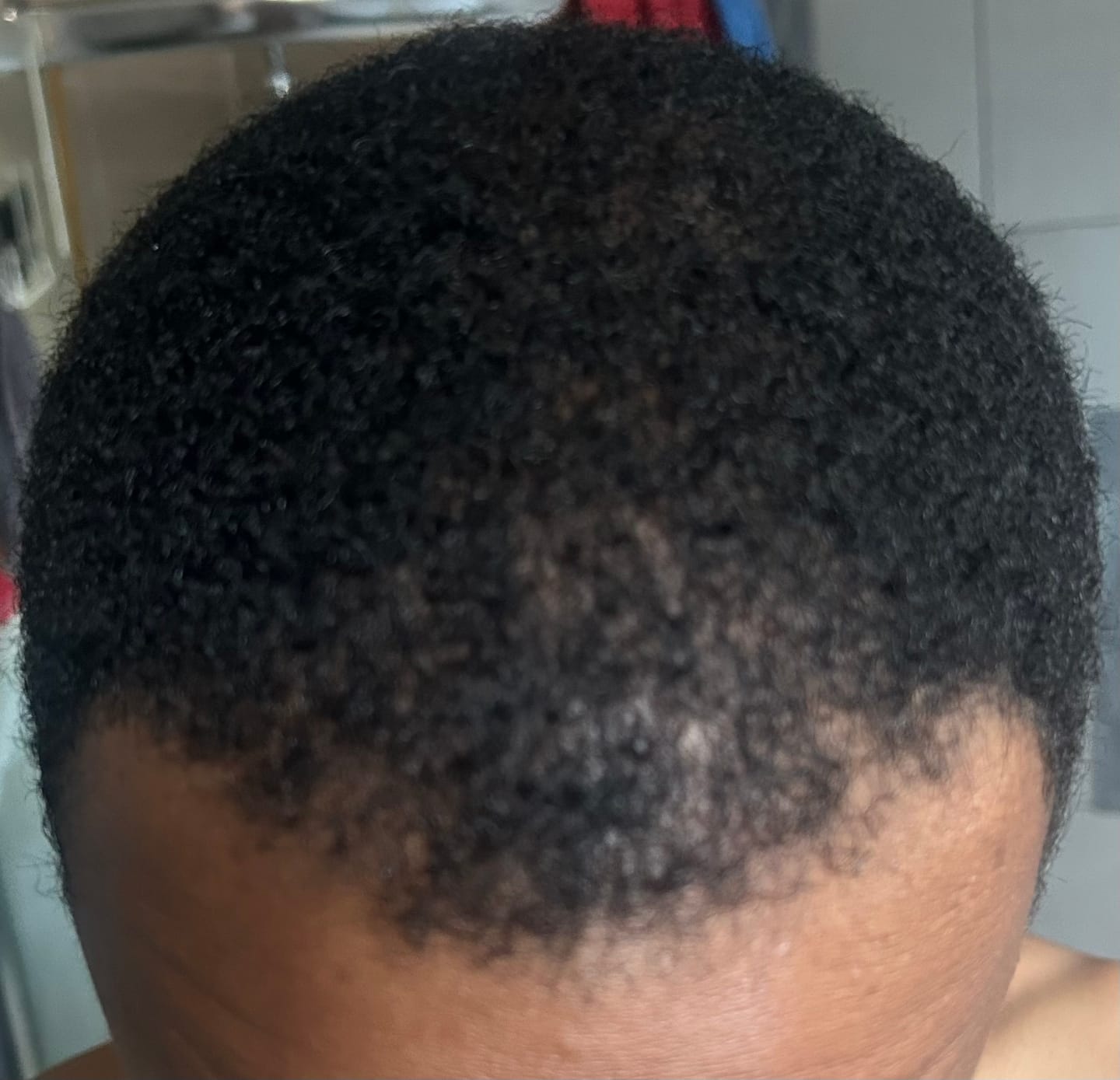 Customer photo review of Minoxidil+DHT Blocker Solution - MEN ONLY, 3x60ml pack