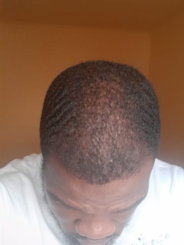 Customer photo review of Minoxidil 5% SOLUTION, 3x60ml pack