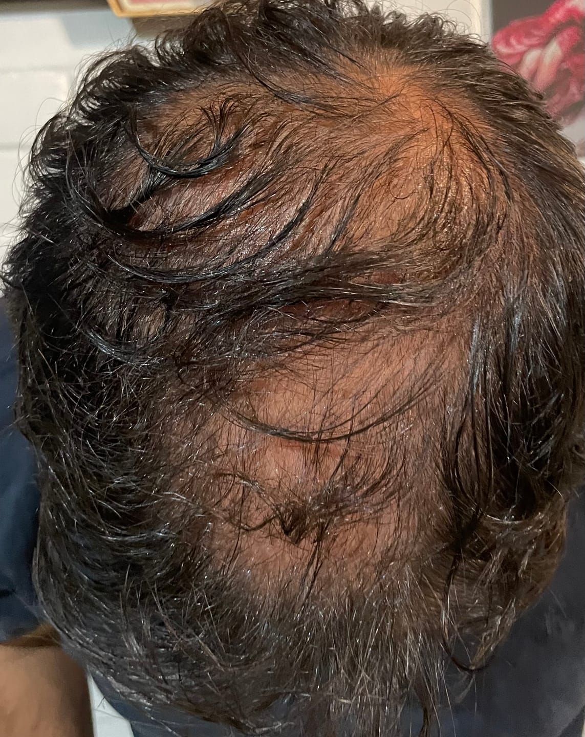 Customer photo review of BOMBA Nutricional ANTIcaída Regenera + Defensas 30 caps.