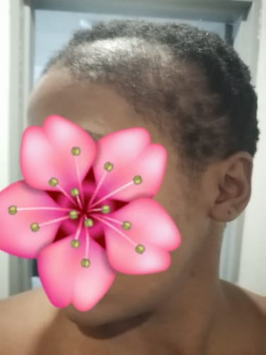 Customer photo review of Minoxidil 5% Solution, 1 Pack 60ml