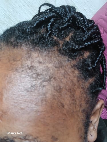 Customer photo review of Minoxidil 5% SOLUTION, 3x60ml pack