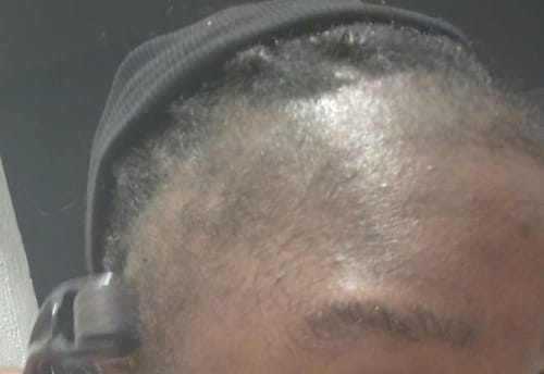 Customer photo review of Minoxidil 5% SOLUTION, 3x60ml pack