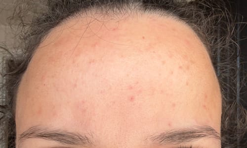 Customer photo review of Salicylic Acid 2% Solution, Exfoliating Serum for Acne