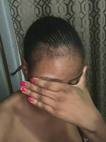 Customer photo review of Minoxidil 5% FOAM, 3x60ml pack