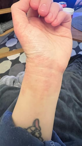 Close-up of a customer's wrist with a red eczema flare-up, which has improved after using the Multi Strain Biotic.