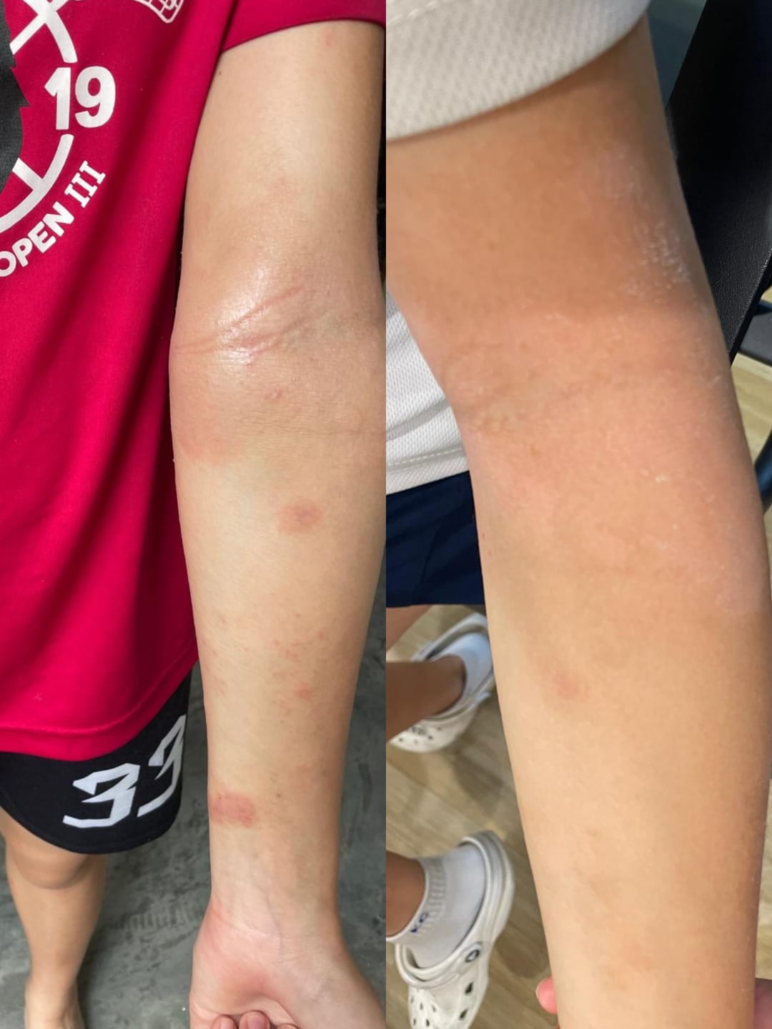 Customer photo review of Eczema Scratch Mitten