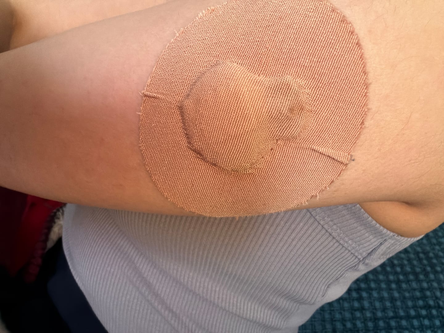 Customer photo review of Skin Grip Original - Medtronic Guardian/Enlite Adhesive Patches