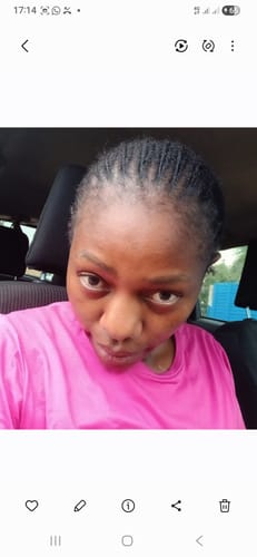 Customer photo review of Minoxidil REGULAR (2%) strength FOAM, 1x60ml pack