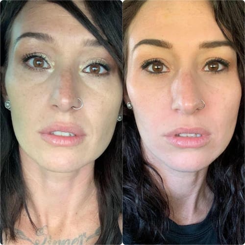 Customer photo review of TV-Set 2 I Serum + Microinfusion-System