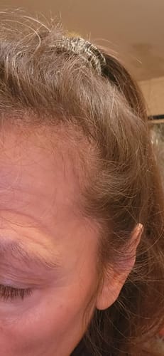 Close-up of a reviewer's hairline, showing new fine hair growth after using the organic shampoo.