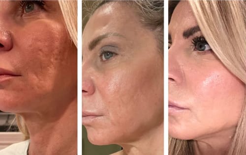 Customer photo review of TV-Set 1 I Serum + Infrarot-Maske