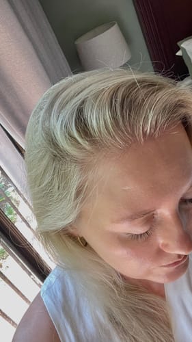 Customer photo review of Minoxidil5% Solution, 1 Pack 60ml