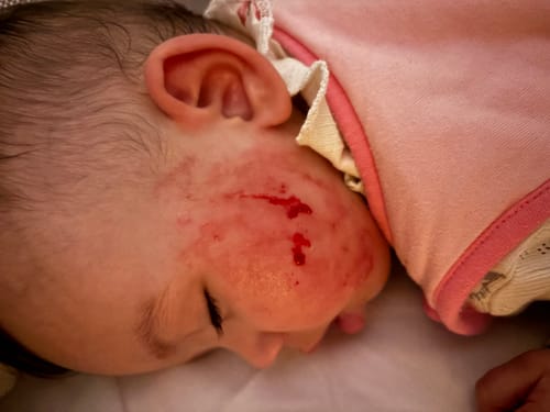 Customer's before photo showing a baby's cheek with severe, red irritation before using the Calm Skin-Relief Kit.