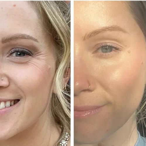 Customer photo review of TV-Set 1 I Serum + Infrarot-Maske