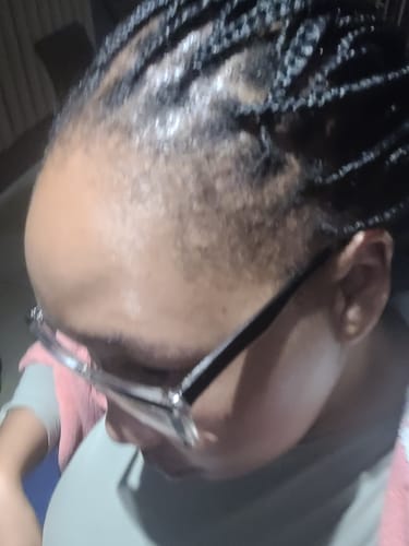 Customer photo review of Minoxidil REGULAR (2%) strength SOLUTION, 3x60ml pack