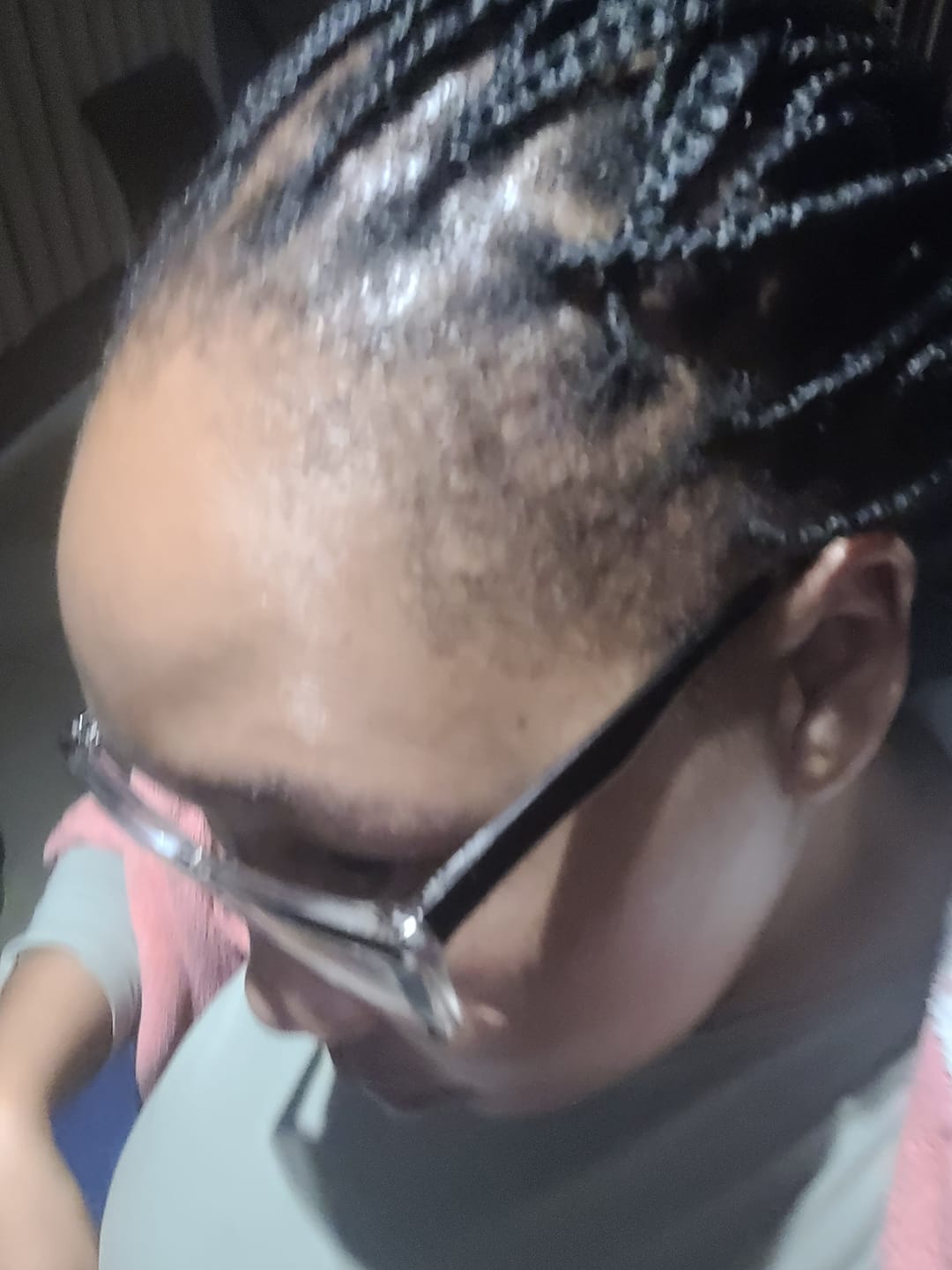 Customer photo review of Minoxidil REGULAR (2%) strength SOLUTION, 3x60ml pack