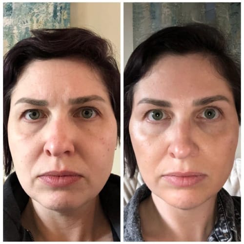 Customer photo review of TV-Set 1 I Serum + Infrarot-Maske