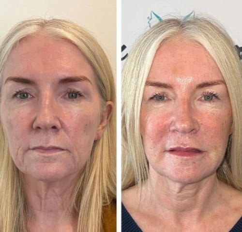 Customer photo review of TV-Set 2 I Serum + Microinfusion-System