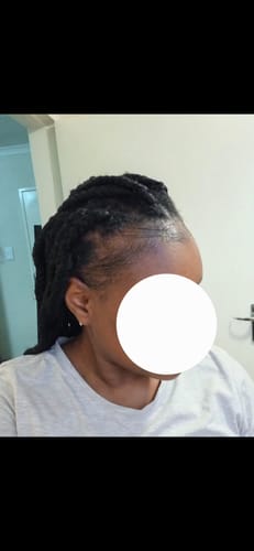 Customer photo review of Minoxidil REGULAR (2%) strength SOLUTION, 1 x 60ml pack