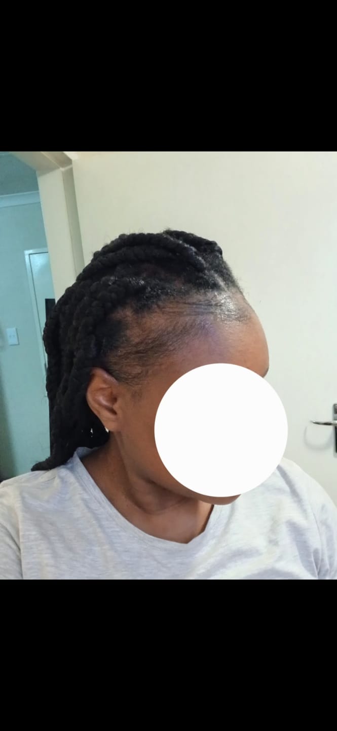 Customer photo review of Minoxidil REGULAR (2%) strength SOLUTION, 1 x 60ml pack