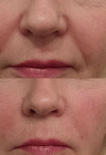Customer photo review of TV-Set 2 I Serum + Microinfusion-System