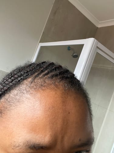 Customer photo review of Minoxidil 5% SOLUTION, 3x60ml pack