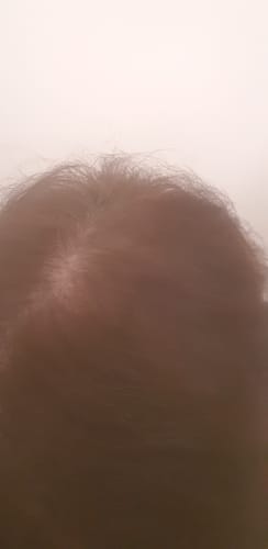 Customer photo review of Minoxidil 5% SOLUTION, 3x60ml pack