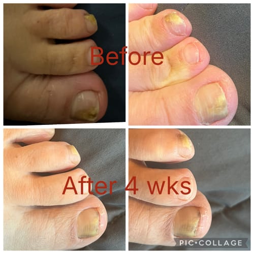 Customer's before-and-after photo collage of toenails, showing visible improvement in nail condition after 4 weeks of using Fungal Freedom.