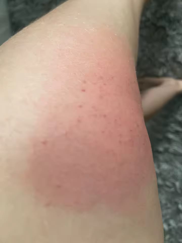 Customer photo review of DrenaSlim® – Dispositivo Drenante AntiCellulite