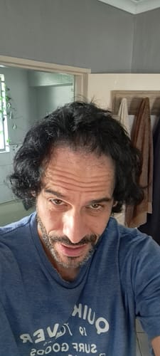 Customer photo review of Minoxidil+DHT Blocker FOAM, MEN ONLY 3x60ml Pack