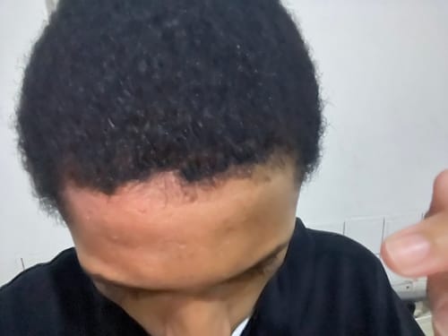 Customer photo review of Minoxidil+DHT Blocker Solution - MEN ONLY, 3x60ml pack