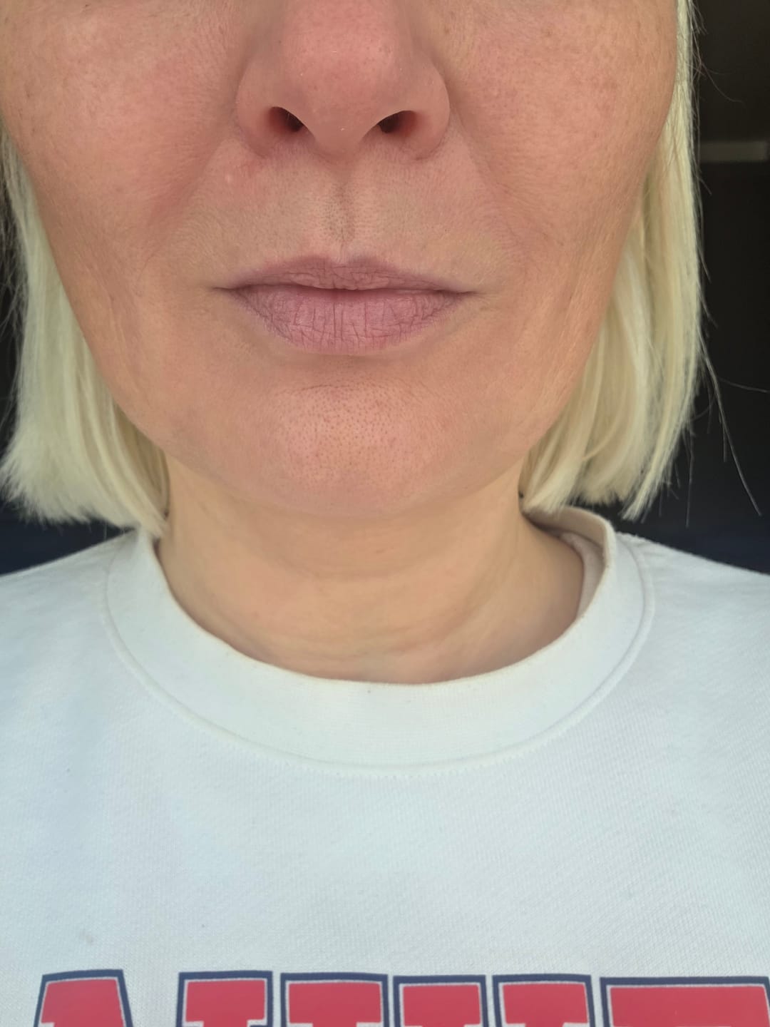 Customer photo review of Liftinga efektu piešķirošs serums ar retinolu un mikroadatām Celimax The Vita−A Retinol Shot Tightening Serum