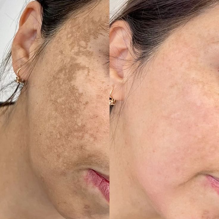 Customer photo review of Bálsamo Anti Melasma. Reduce manchas en 7 días