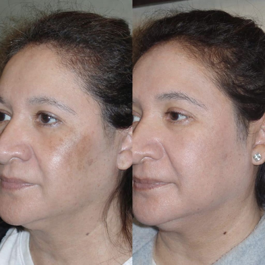 Customer photo review of Labbok Skin Lightening Cream, 30ml