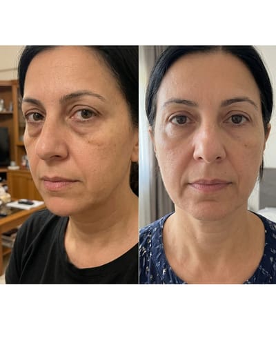 Customer photo review of Labbok Eye Cream dark circles puffiness, 20ml